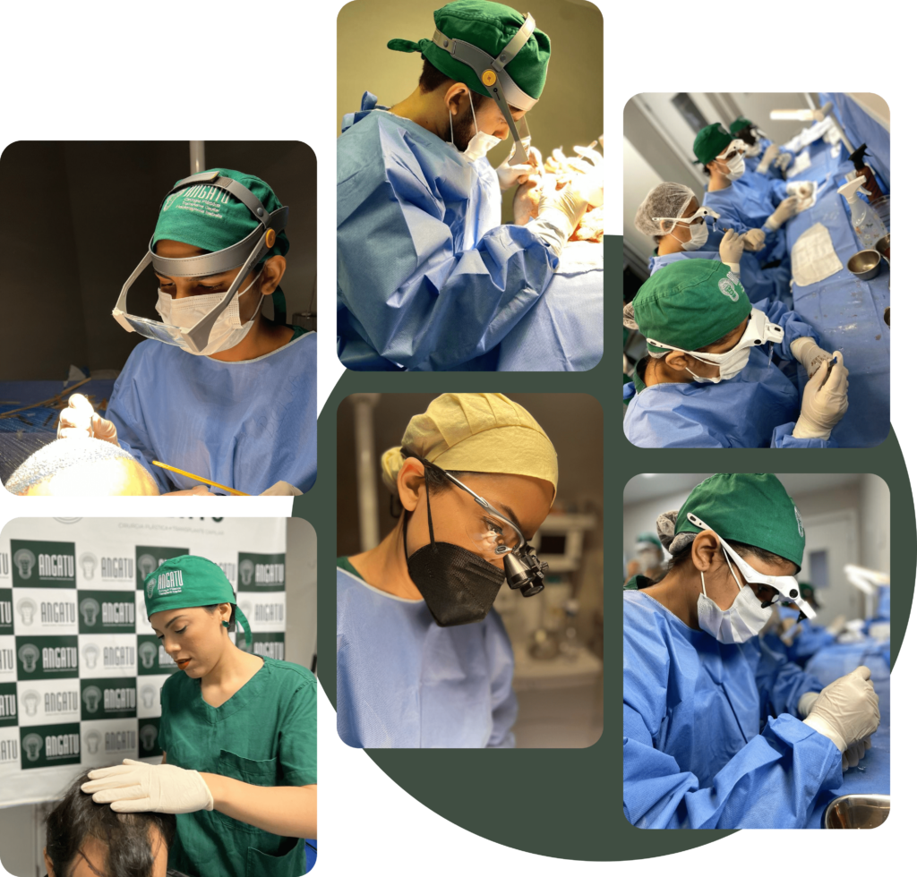 transplante-capilar-barba-e-sobrancelha-dr-matheus-pantoja